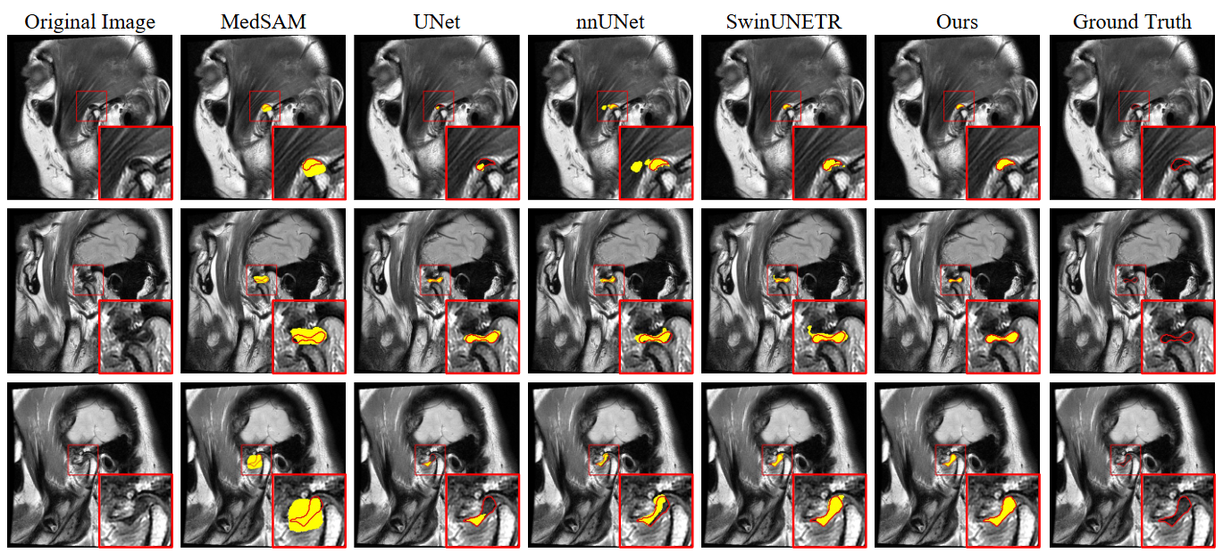 TMJ Disc Segmentation